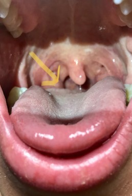 Halsschmerzen Teil 2: Angina, Scharlach, Halsweh, Streptokokken