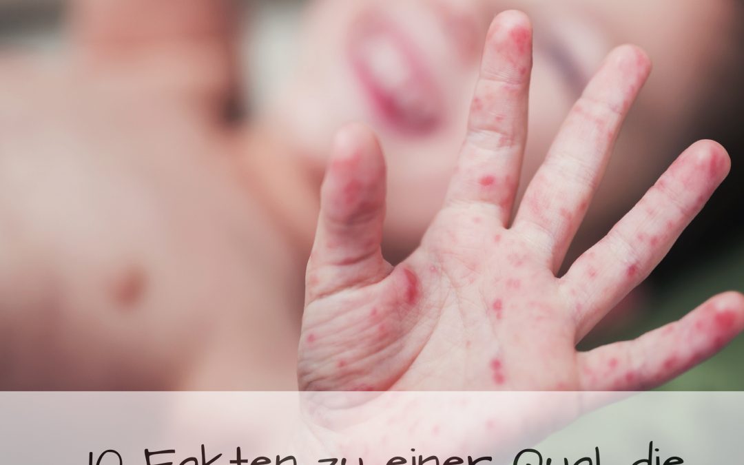 Die Hand-Fuß-Mund-Krankheit: eine Qual für Kinder und Erwachsene